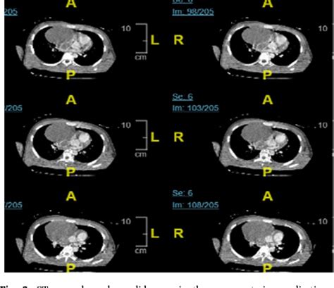 A Rare Case Of Life Threatening Mixed Germ Cell Tumor Infiltrating The