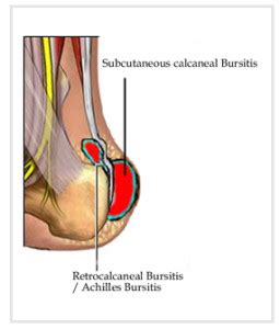 Achilles Bursitis Treatment | OSMO Patch US