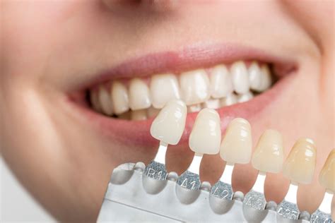 What Are The Differences Between Composite Resin Bonding & Veneers ...