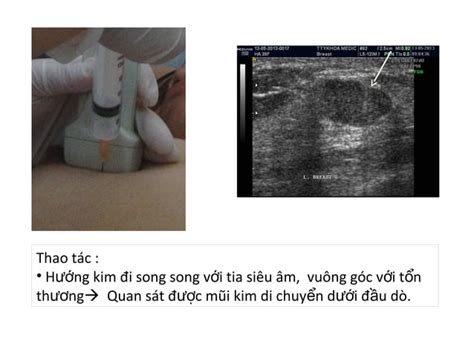 Ultrasound Guided Breast Fnac Ppt