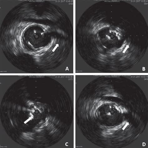 Intravascular Ultrasound Directed Aortic Stent Graft Body Repositioning