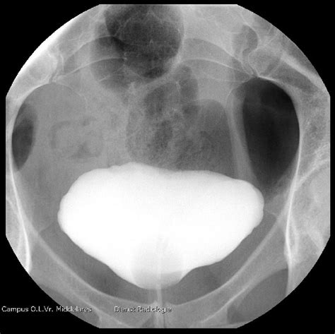 Postoperative Cystogram On Day 8 Showing An Intact Wall Of The Urinary Download Scientific