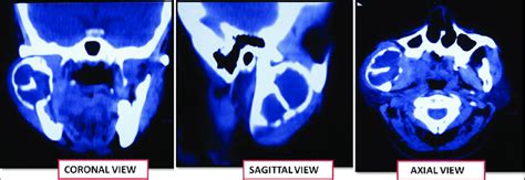 Computed Tomography Scan Showing Expansile Lytic Nonenhancing Lesion Download Scientific