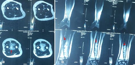 Periosteal Desmoplastic Fibroma Of Radius A Rare Bone Tumor Apsp