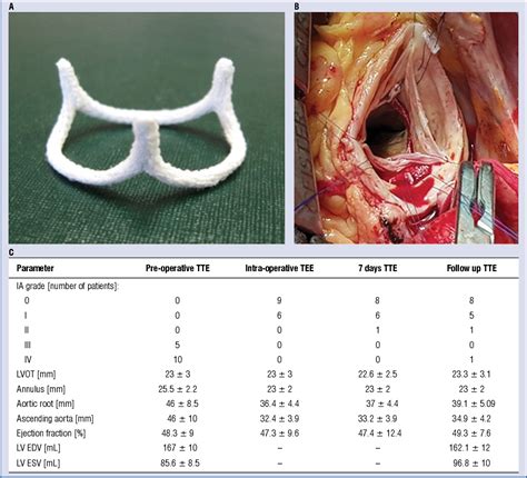 Figure From Surgical Correction Of Aortic Regurgitation Using A Haart