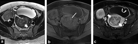 A 46 Year Old Woman With Uterine Leiomyoma With Myxoid Degeneration Download Scientific