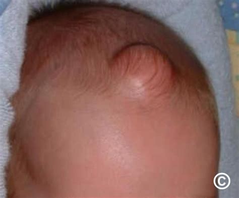 Epidermoid Cyst Scalp