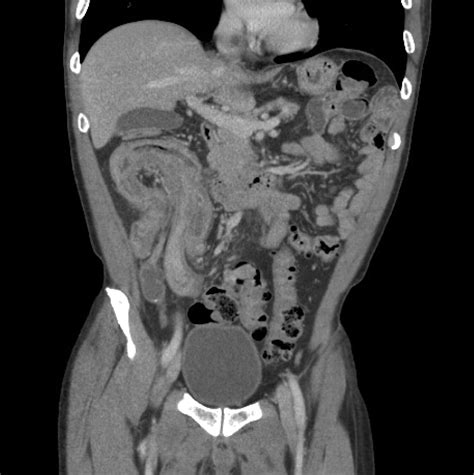 Adult Ileocolic Intussusception Secondary To Ileocaecal Valve Polyp