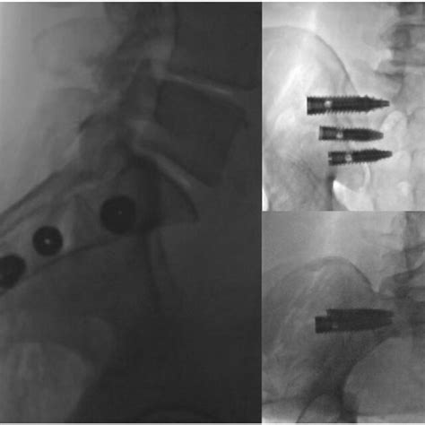 Posterior Oblique Fusion Of The Sacroiliac Joint Series Of Images