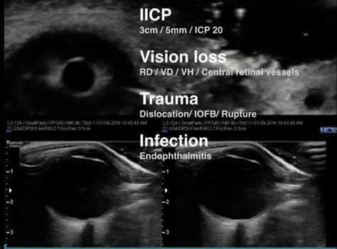 Pocus Academy Point Of Care Ultrasound Is The Visual Stethoscope In The 21st Century