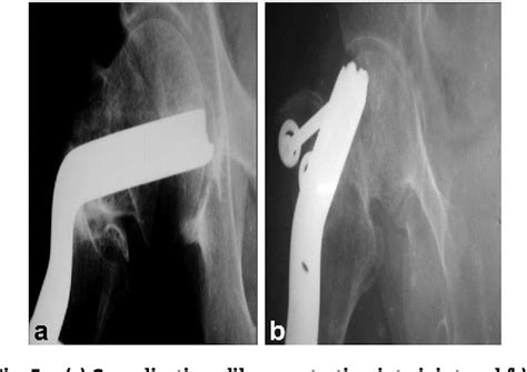 Figure 1 From Evaluation Of Valgus Intertrochanteric Osteotomy In