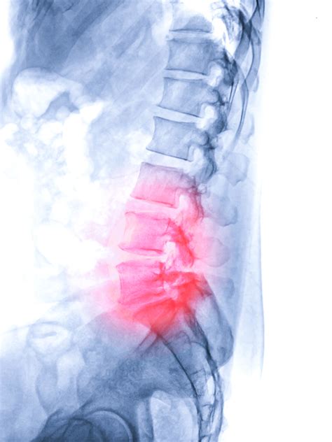 Different Types Of Spine Surgery Orthopaedic Associates