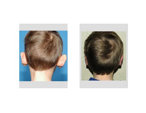 Case Study: Otoplasty Surgery for Protruding Ears - Explore Plastic Surgery