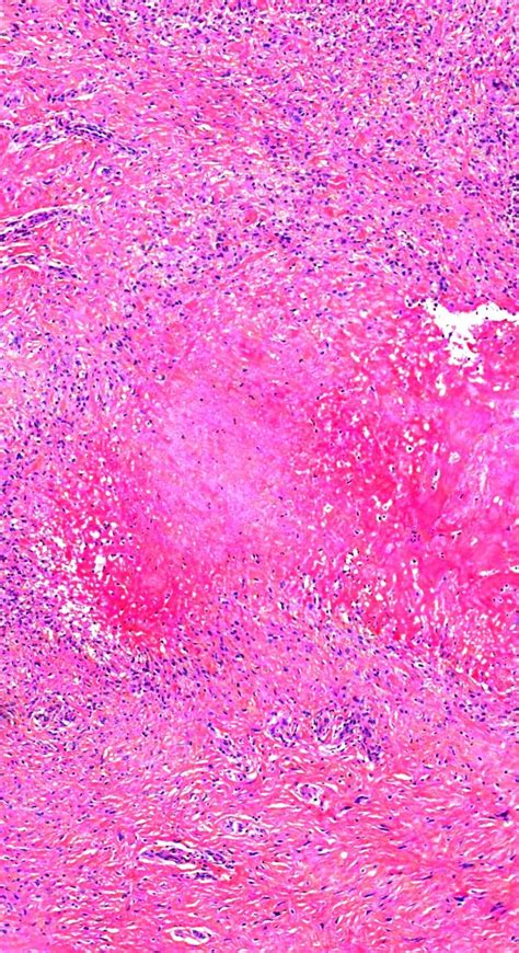 Pathology of Granuloma Annulare in 2023 | Pathology, Granuloma annulare, Animation