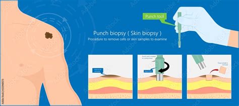 Skin Biopsy Dermoscope Tool Surgical Diagnose Lupus Rash Cell Exam