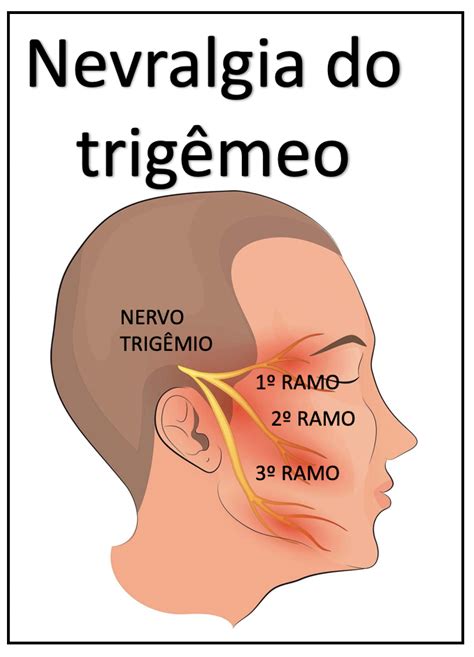 Nevralgia Do Trig Meo Medicina De Excel Ncia