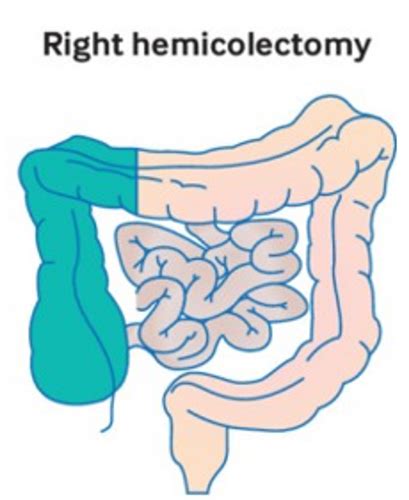 Colorectal Surgery Past Present And Future Flashcards Quizlet