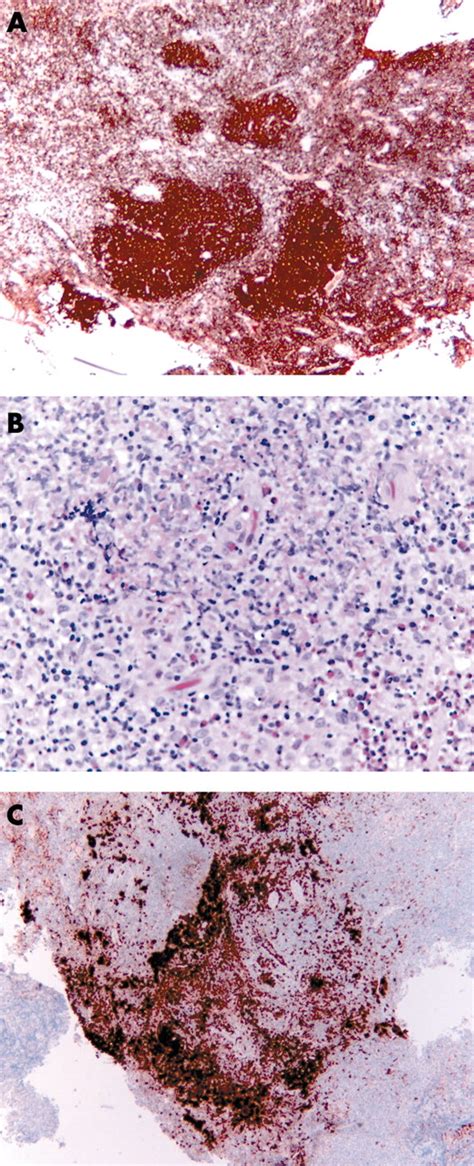 Langerhans Cell Histiocytosis In Sequential Discordant Lymphoma