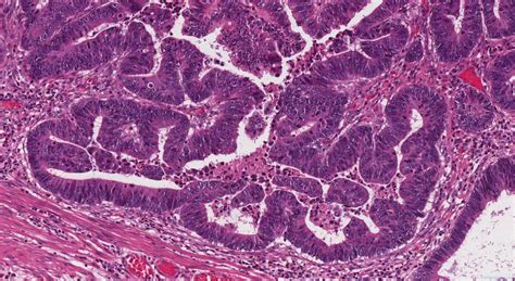 Tubular Adenoma Of The Colon Atlas Of Pathology