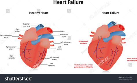 4 Left ventricular ejection fraction Images, Stock Photos & Vectors ...