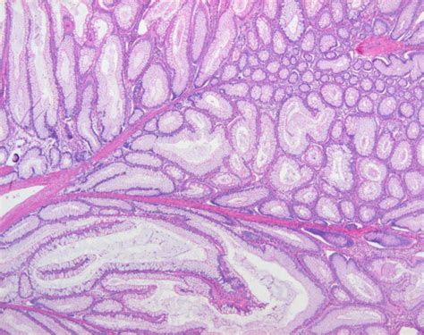 Pathologic findings of the Peutz-Jeghers polyp. The colonic polyp shows ...