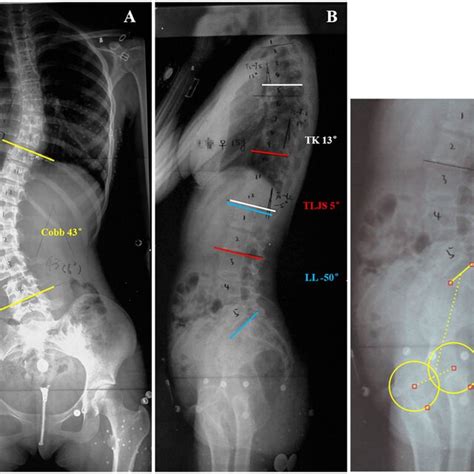 This Is A 14 Year Old Girl With Lenke Type 5 Adolescent Idiopathic Download Scientific Diagram