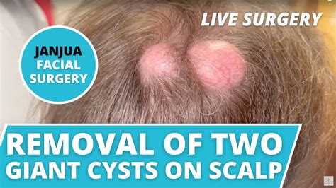 Removal Of Two Large Cysts On The Scalp Live Surgery Dr Tanveer