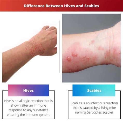 Urticaria Vs Sarna Diferencia Y Comparación