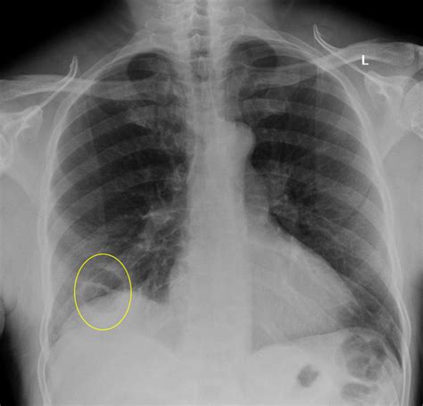 Cavitary lesion visible in the right lower lobe (yellow circle ...