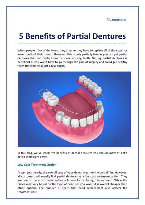 Ppt Benefits Of Partial Dentures Powerpoint Presentation Free