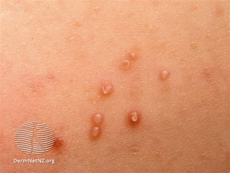 Molluscum Contagiosum — Skin For All