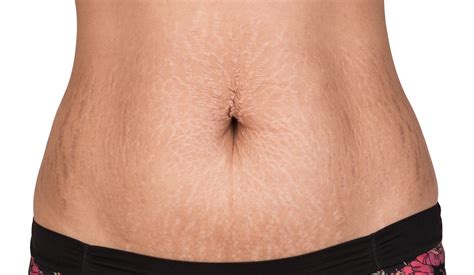 Are Stretch Marks Permanent The Skin Clinic Scottsdale