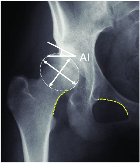 The Right Hip Of An Ap Pelvis Radiograph Of A 28 Year Old Patient With