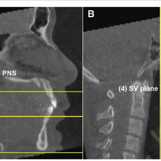 Pharyngeal Airway Division And Measurements A The Airway Space Divided