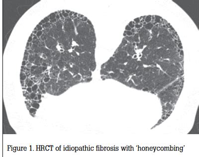 interstitial lung diseases ilds  gp notes
