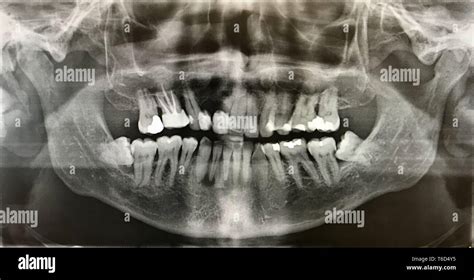 x-ray photo of human teeth Stock Photo - Alamy