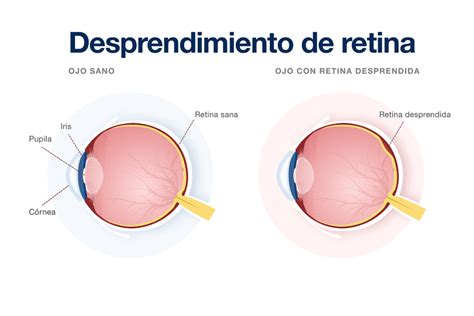 Desprendimiento de retina Oftalmología Avanzada