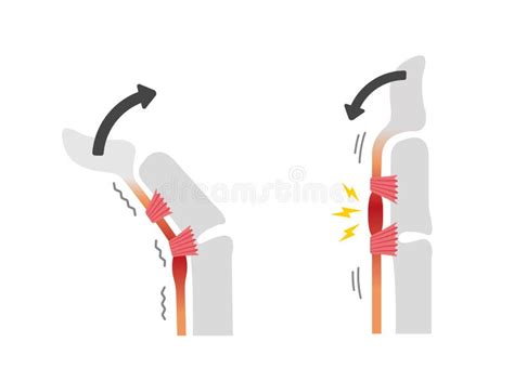 Trigger Finger Causes And Symptoms Illustration Stock Vector