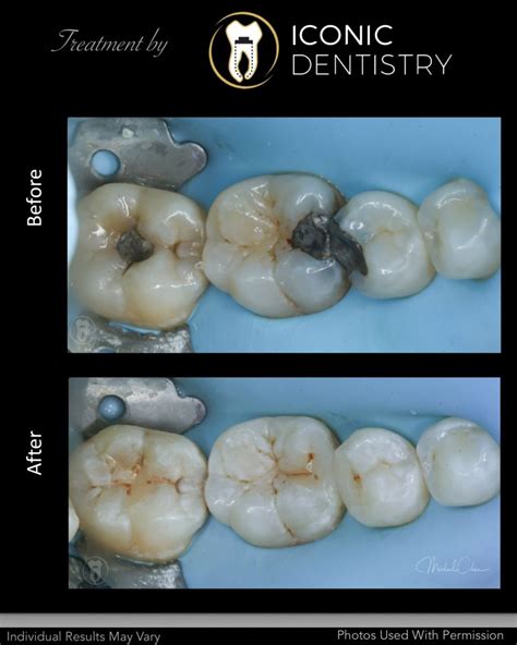 Tooth Cavity Fillings White Fillings Iconic Dentistry