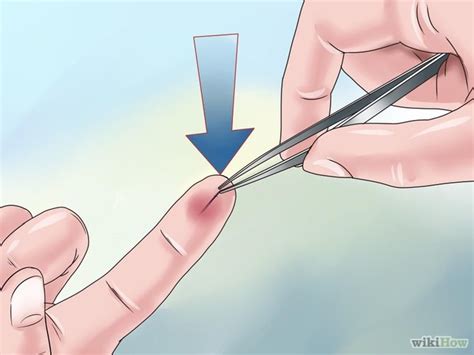 Healthcare Times - How to Remove a Splinter