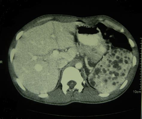 Contrast Enhanced Computed Tomography Scan Of The Abdomen Showing