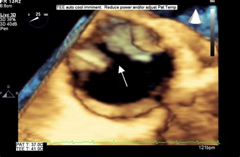 The Value Of Three Dimensional Transesophageal Echocardiography In