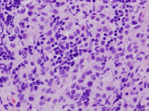 Pathology Outlines Langerhans Cell Histiocytic Neoplasms