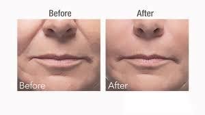 Botox Wrinkle Treatment at Rs 10000/per sitting in Kolkata | ID ...