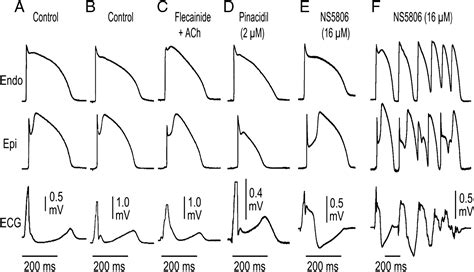 J Wave Syndromes Brugada And Early Repolarization Syndromes Heart Rhythm