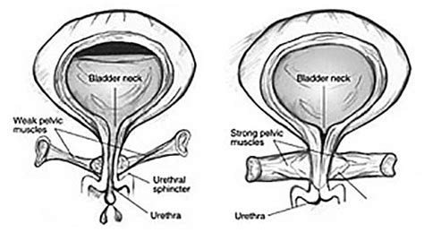 Urinary Incontinence Donald Gordon Medical Centre Johannesburg