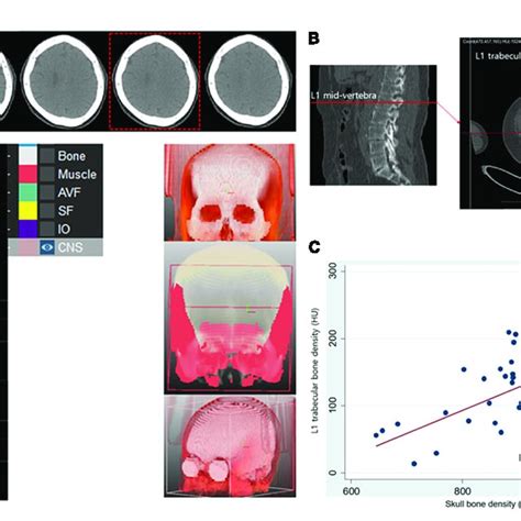 Measurement Of Hounsfield Unit In Skull And Lumbar Bone And Their Download Scientific Diagram