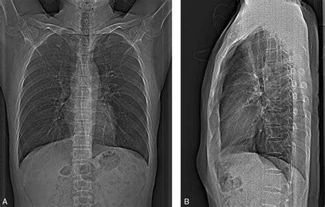 An Example Of The Ap A And Lateral B Scout Views Used For Chest Ct