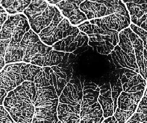 Heidelberg Engineerings Oct Angiography Fda Cleared For Eye