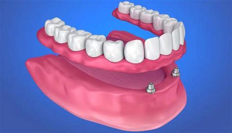 Care Este Cea Mai Buna Proteza Dentara Totala Dental Premier